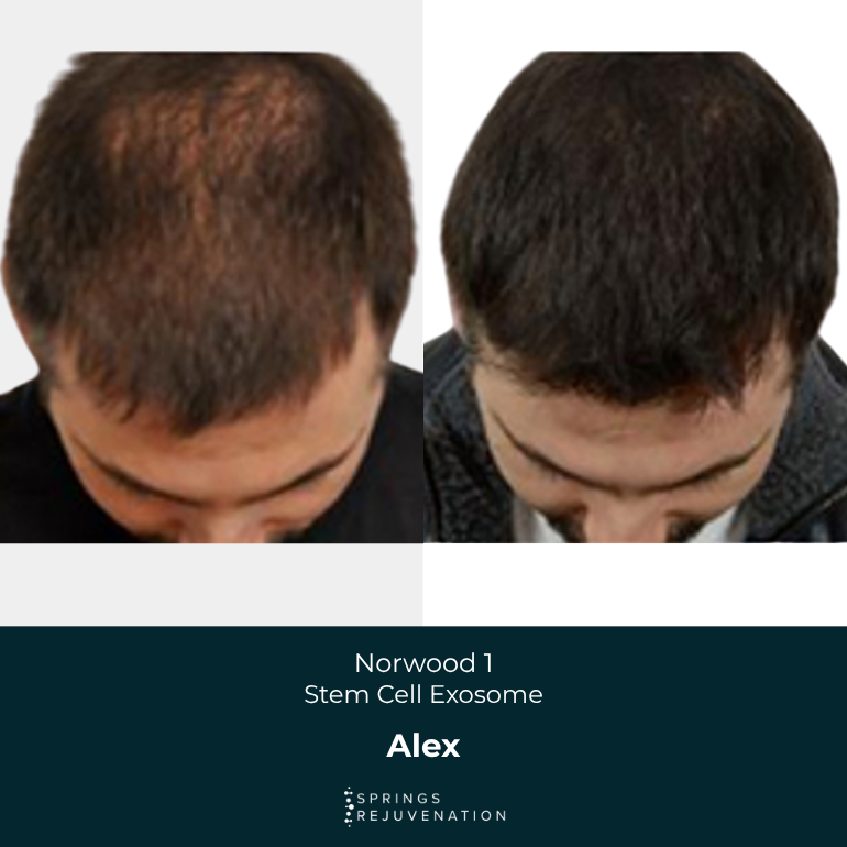 Alex - Before & After